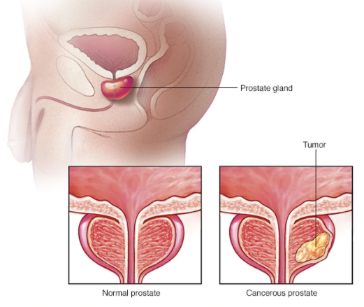 Prostate 911 Supplement