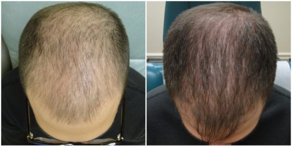 Hairfortin Before & After Results